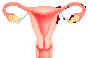Endometrioza